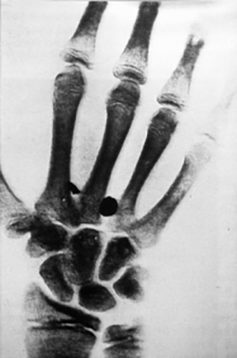 Aufnahme der Hand eines 16-jährigen Patienten vom 29. Mai 1896 in Basel